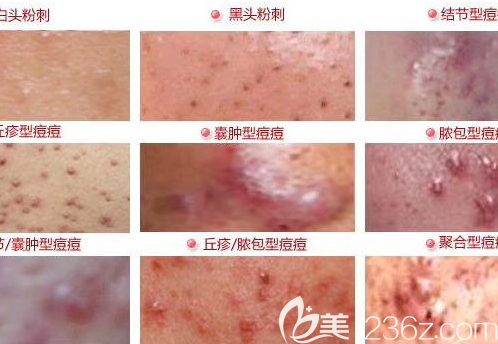 痘痘的種類(lèi)及具體類(lèi)型示意圖