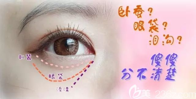 淚溝和眼袋區(qū)別介紹