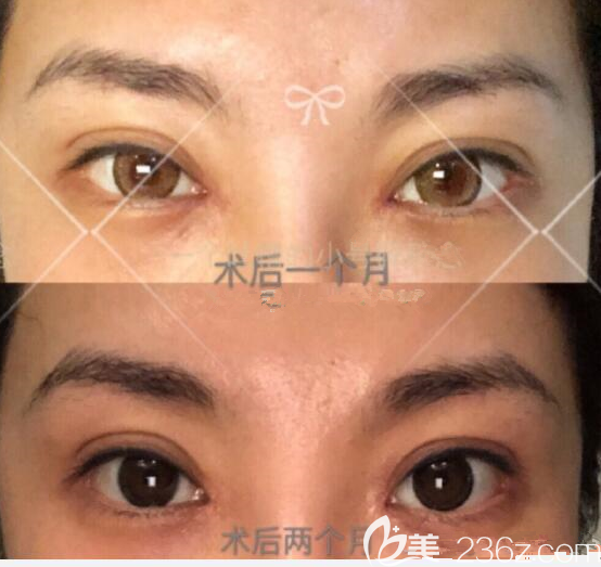 韓國eve鄭潤載做眼角修復(fù)真人案例 韓國eve鄭潤載做眼角修復(fù)真人案例