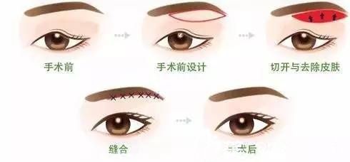做上瞼下垂矯正的手術(shù)步驟簡(jiǎn)易圖