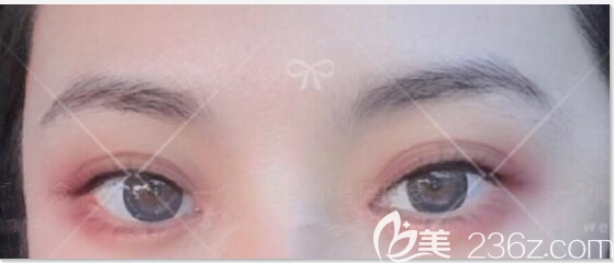 我在韓國(guó)eve鄭潤(rùn)載做了眼角修復(fù)院長(zhǎng)算是負(fù)責(zé)我目前比之前好