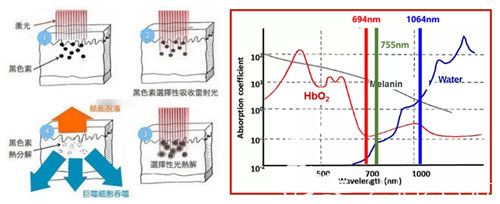 紅寶石點陣激光祛黃褐斑原理 紅寶石點陣激光祛黃褐斑原理