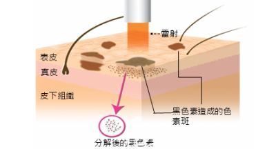 紅寶石點陣激光術后無色沉問題 紅寶石點陣激光術后無色沉問題