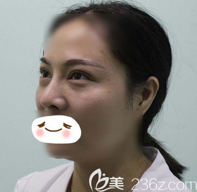 在漯河締美儷做膨體隆鼻2周后