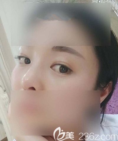 在漯河締美儷做了膨體隆鼻3個月恢復(fù)后再也不用被說是照“騙”了