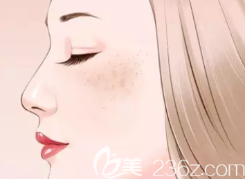 面部長雀斑示意圖