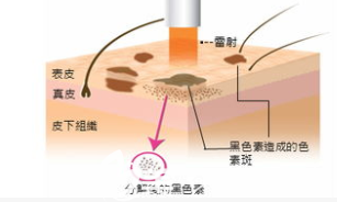 激光去雀斑原理示意圖