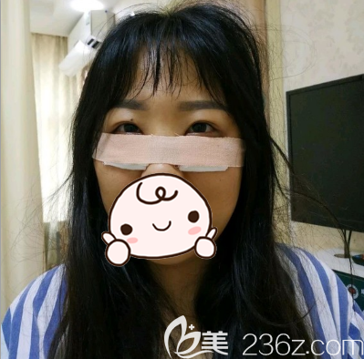 內(nèi)切去眼袋術(shù)后即刻