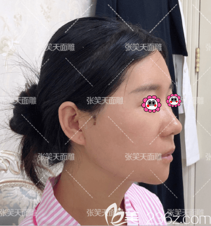 北京圣嘉新張笑天磨骨多少錢？我在北京圣嘉新做顴骨和下頜角價格不貴效果還行