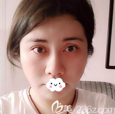 <!--<i data=20240703-sp></i>-->鐘正強(qiáng)中下面部線雕術(shù)后效果圖