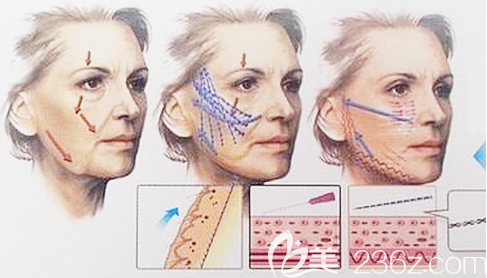 面部線雕埋線提升手術(shù)示意圖