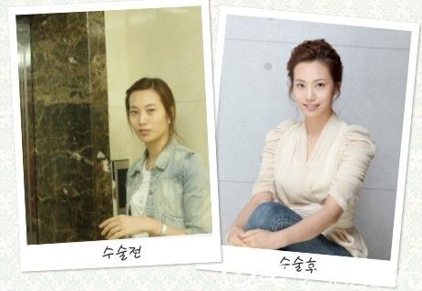 韓國那木MMPRP脂肪移植