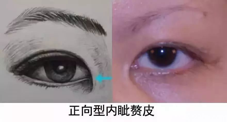 正向型內眥贅皮圖解