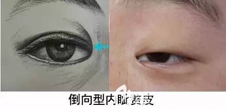 倒向型內眥贅皮圖解