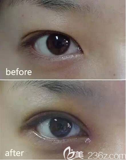 輕度內眥贅皮矯正前后對比圖