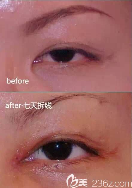 重度內眥贅皮矯正前后對比圖