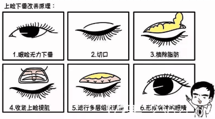 上瞼下垂手術(shù)過程