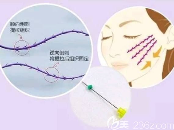 線雕提升原理圖