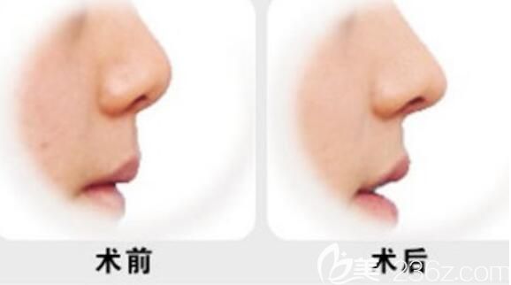 隆鼻手術(shù)療效對(duì)比圖