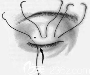 埋線雙眼皮手術(shù)如何施術(shù)示意圖