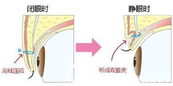 埋線雙眼皮睜眼閉眼形態(tài)
