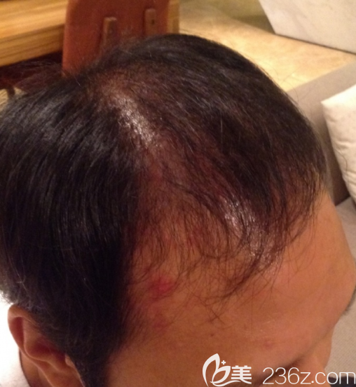 韓國JP做毛發(fā)移植怎么樣