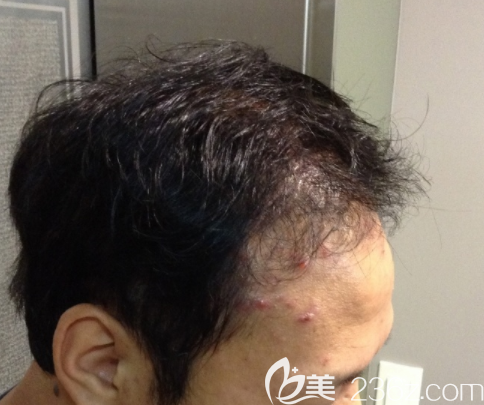 韓國JP崔鐘弼毛發(fā)移植怎么樣