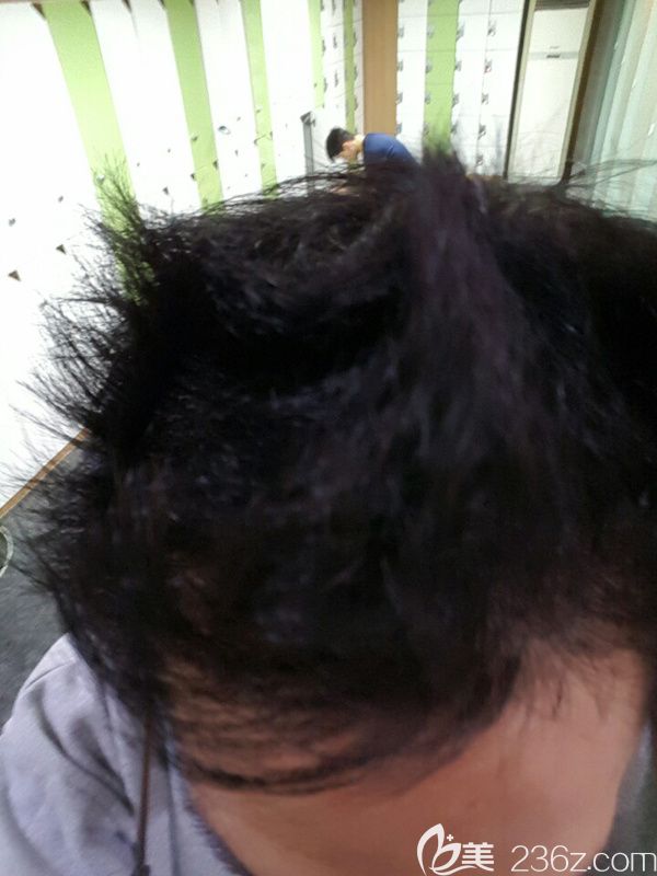 韓國(guó)jp毛發(fā)移植案例