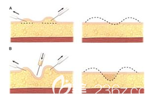 吸脂后凹凸不平的樣子