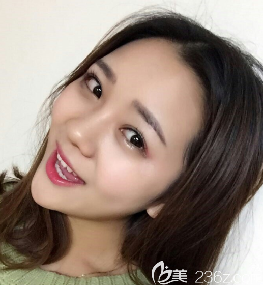 韓國奧斯卡眼睛真人案例