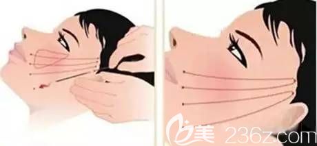 6S逆時(shí)空線雕術(shù)技術(shù)優(yōu)勢(shì)簡介