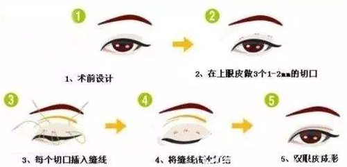 全切雙眼皮手術(shù)示意圖