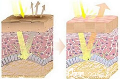 激光美白治療的手術原理