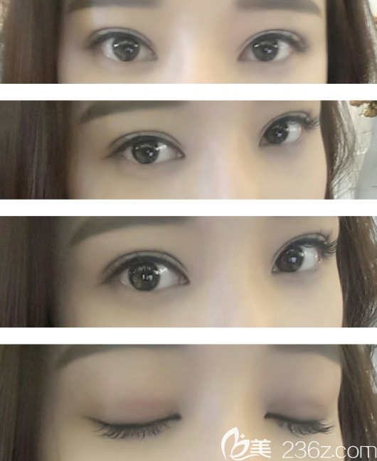 奧斯卡歐式雙眼皮真人案例