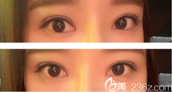 奧斯卡Oscar埋線法修復(fù)后變歐式大歐雙好喜歡線條很美