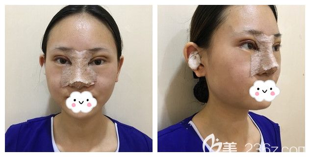 冰敷兩天后眼鼻恢復(fù)情況 冰敷兩天后眼鼻恢復(fù)情況