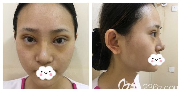 一周拆線眼鼻恢復(fù)情況 一周拆線眼鼻恢復(fù)情況