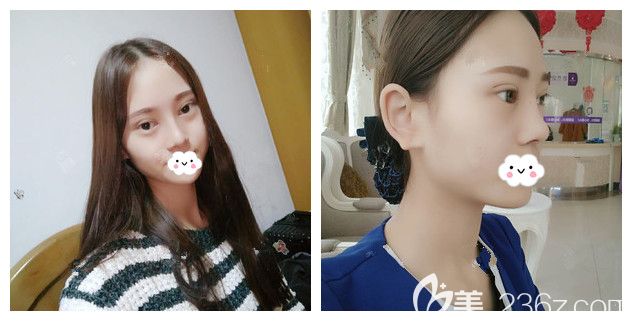 做完硅膠+自體耳軟骨隆鼻+翹睫美瞳雙眼皮術(shù)后半個月恢復(fù) 做完硅膠+自體耳軟骨隆鼻+翹睫美瞳雙眼皮術(shù)后半個月恢復(fù)