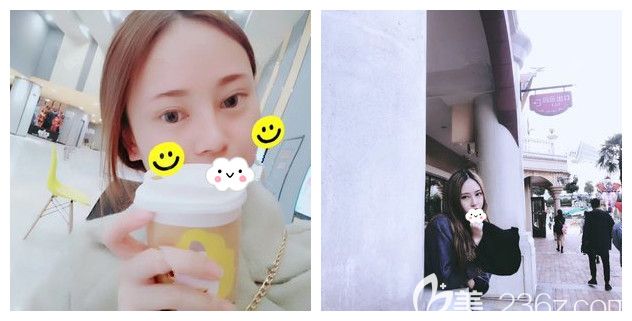 泰州麗都整形內(nèi)部員工分享硅膠+自體耳軟骨隆鼻+翹睫美瞳雙眼皮術(shù)后一年蛻變照片