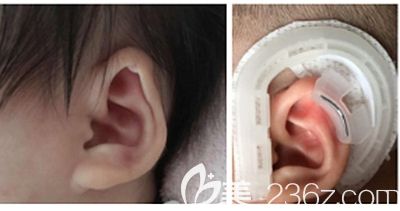耳畸形矯正器