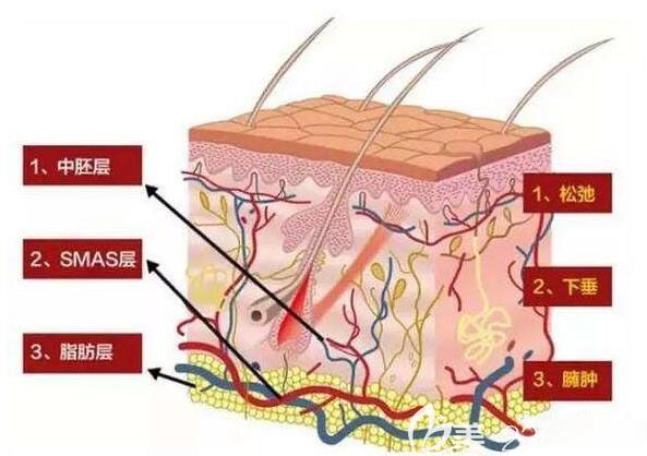 皮膚層次分類與埋線位置示意圖