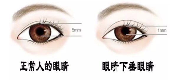 上瞼下垂和正常人的眼睛對(duì)比示意圖