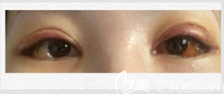 韓國(guó)Gio眼角真人案例