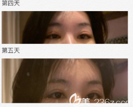 韓國(guó)Gio做眼睛怎么樣