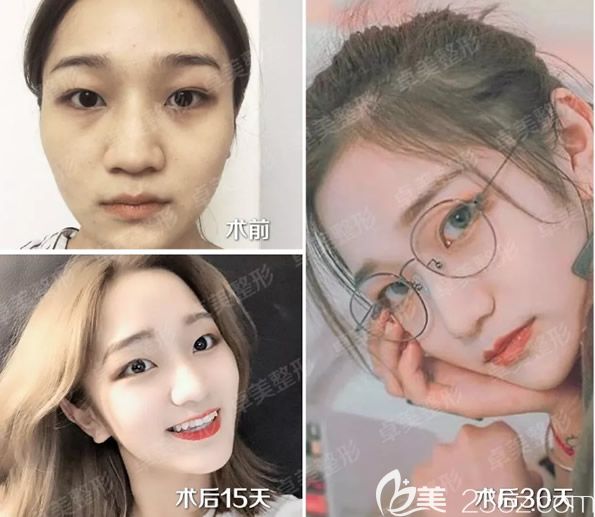 真人全臉脂肪填充前后效果對比照片