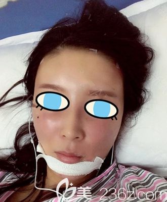 南陽維多利亞面部填充術(shù)后即刻