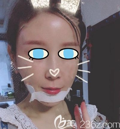 南陽維多利亞面部填充術(shù)后第3天