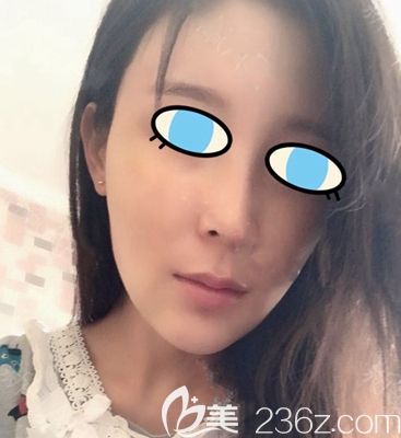 南陽維多利亞面部填充后15天