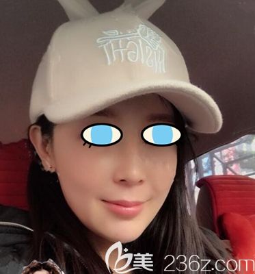 如果想去南陽(yáng)做自體脂肪面部填充可以參考我這份案例對(duì)比照