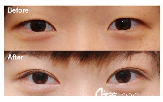 雙眼皮消失前后效果